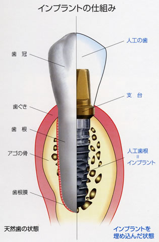 インプラントの仕組み