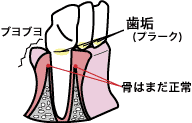歯周炎の図