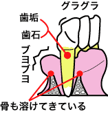 歯周病中程度の図