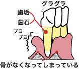 歯周病重症の図