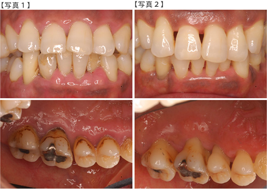 歯周病治療その1