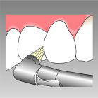 プロによる歯のクリーニング（PMTC）